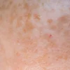 Human Melanocytes for Skin Research