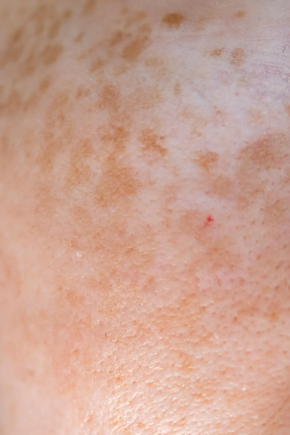 Human Melanocytes for Skin Research