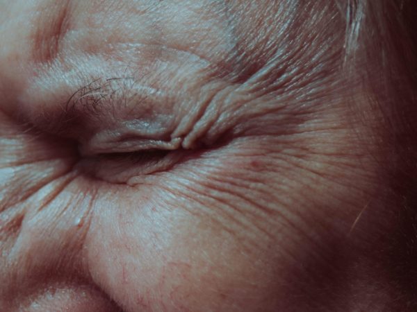 Human Epidermal Keratinocytes for Skin Research