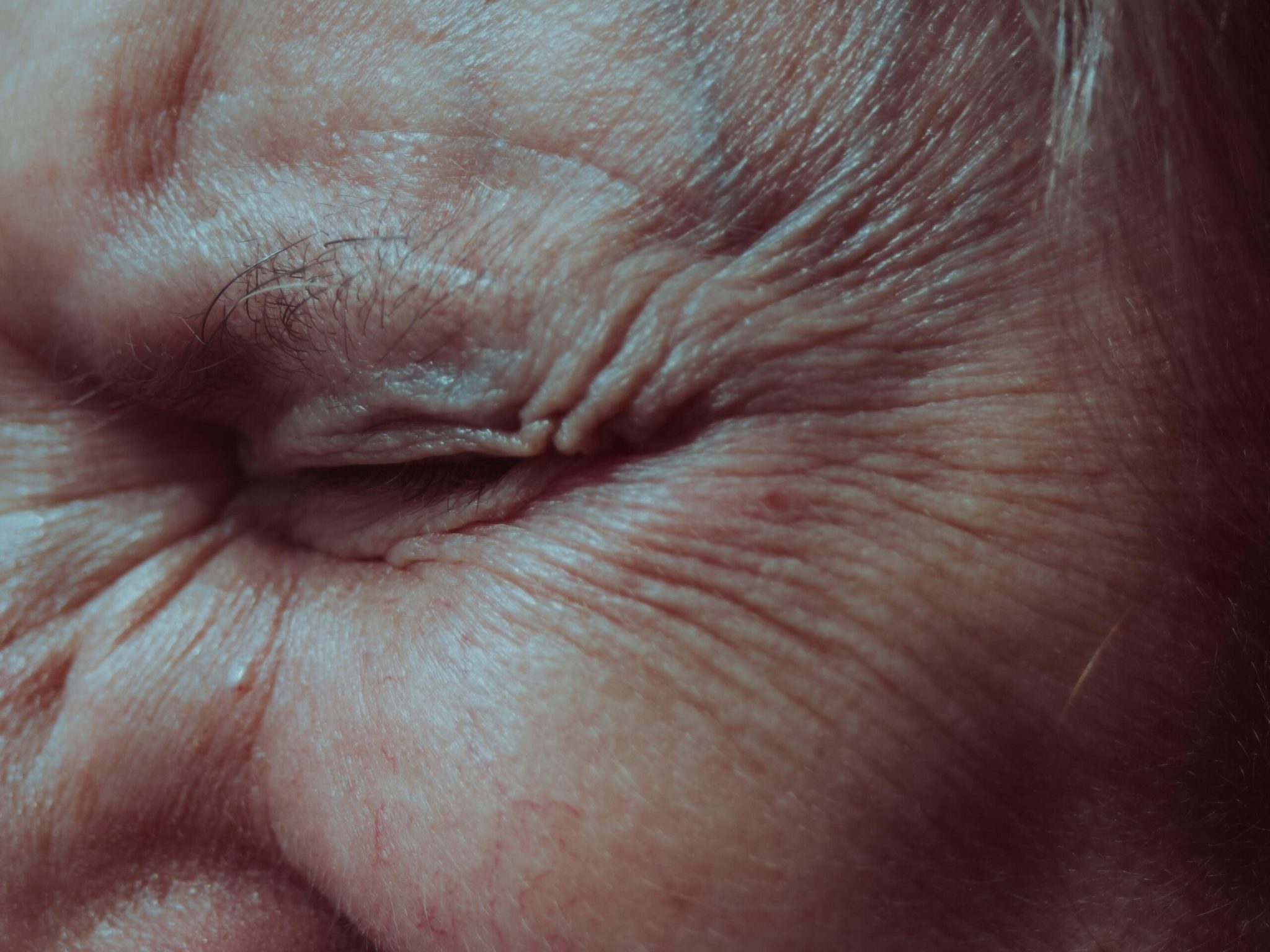Human Epidermal Keratinocytes for Skin Research