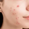 Human Sebocytes, Cryopreserved