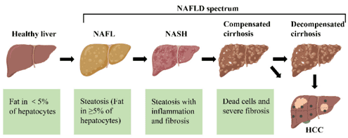 Figure 2: Different stages of non-alcoholic fatty liver disease (NAFLD). Credit: Guo, X.; Yin, X.; Liu, Z.; Wang, J. https://doi.org/10.3390/ijms232415489 reproduced under Creative Commons license