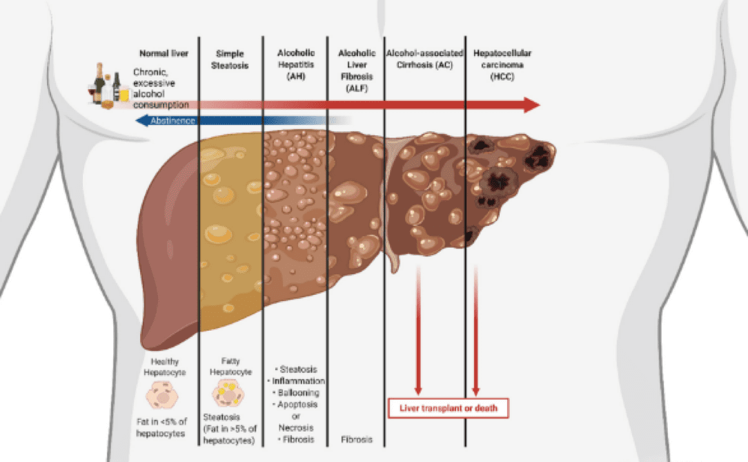 Figure 3: Alcohol-associated liver disease (ALD) spectrum. Credit: Way, G.W.; Jackson, K.G.; Muscu, S.R.; Zhou, H. doi.org/10.3390/cells11081374 reproduced under Creative Commons license