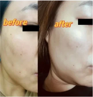 Before (left) and three months after (right) treatment using umbilical cord mesenchymal stem cells derived exosomes.